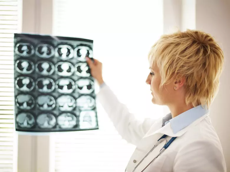 Uso del litio en el tratamiento del deterioro cognitivo tras la radioterapia