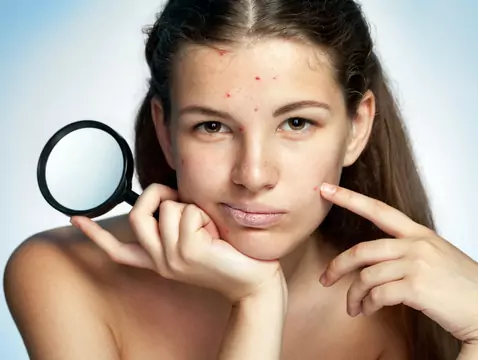 Tratamientos farmacológicos para el acné