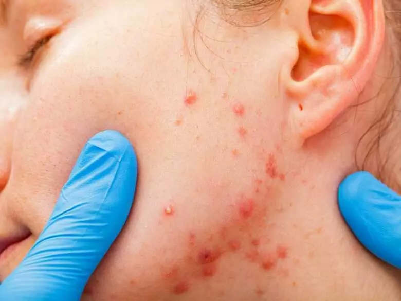 Antibióticos en el tratamiento del acné: ¿cuándo se utilizan?