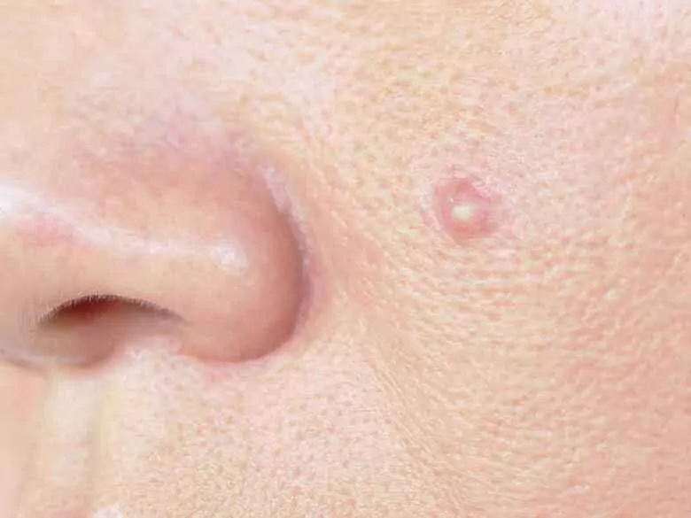 Formas atípicas de rosácea