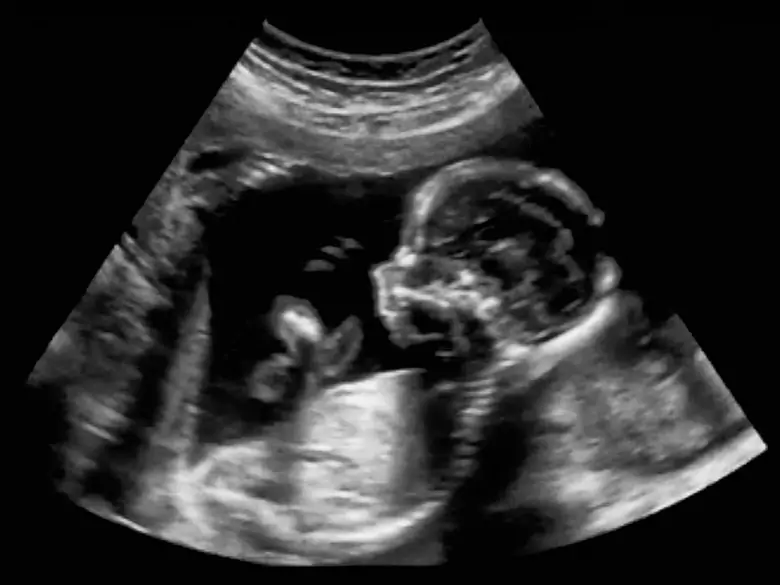 Trastornos del crecimiento fetal