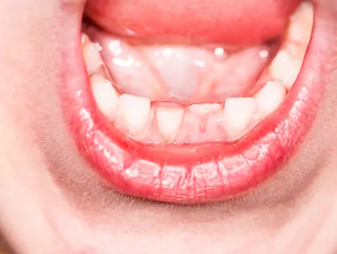 Estomatitis fúngica - causas, síntomas, diagnóstico, tratamiento