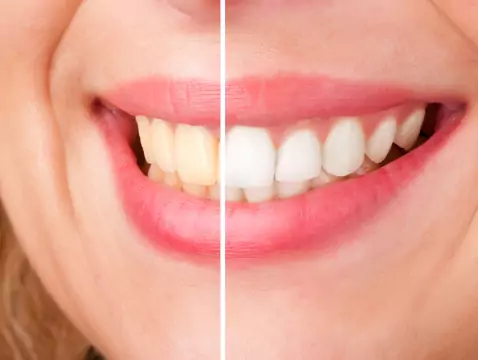 Blanqueamiento dental con láser: ¿la esencia del procedimiento?