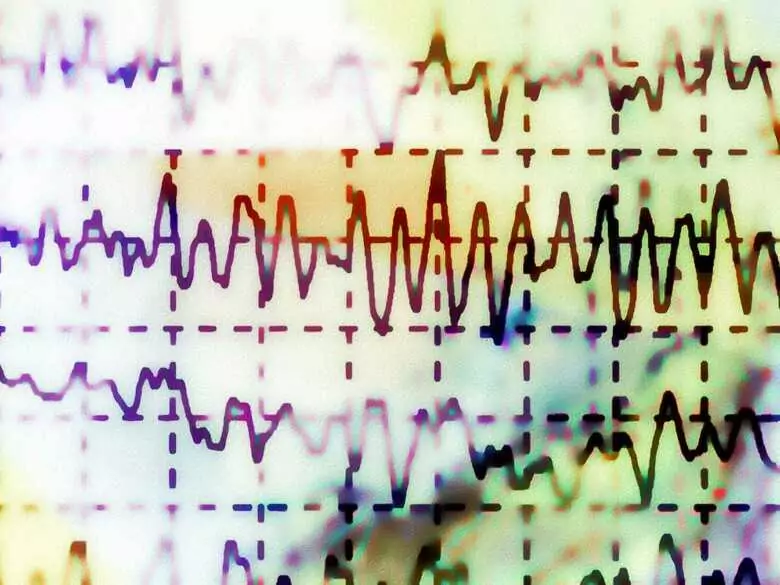 Canalopatías - síndromes determinados genéticamente que causan arritmias cardiacas