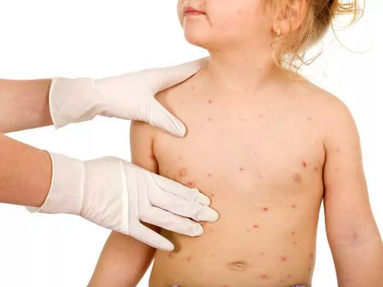 Remedios caseros para aliviar los síntomas de la varicela