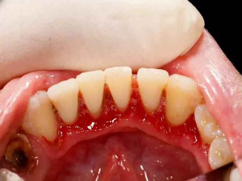 Leucemia y hemorragias y lesiones en la boca