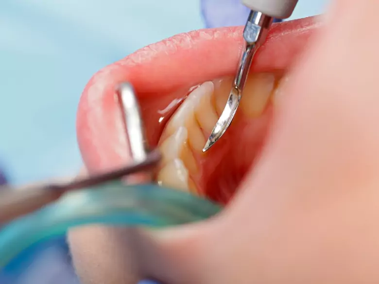Absceso dental: lo que debe saber sobre él