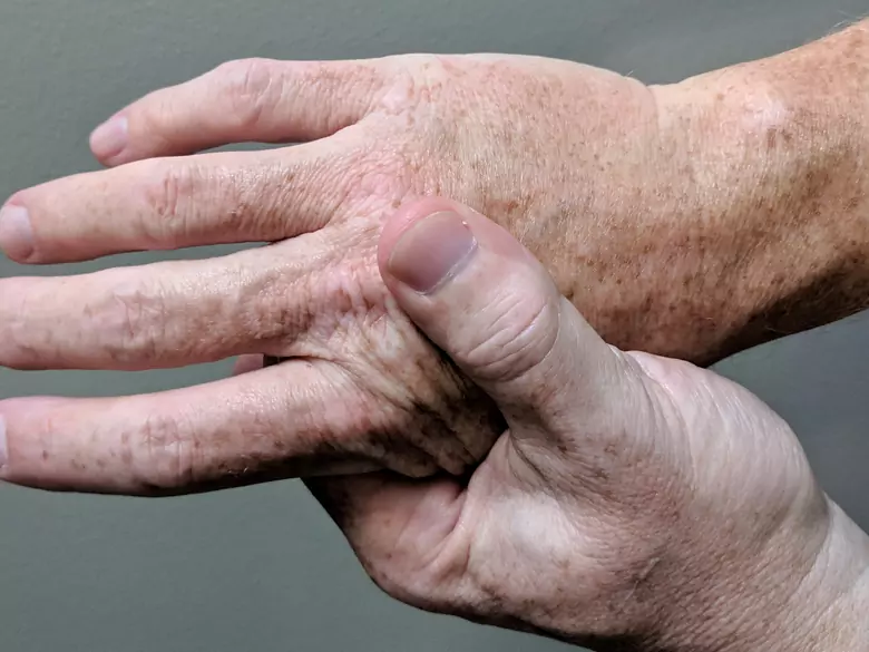 ¿Cómo afrontar los problemas de artritis?