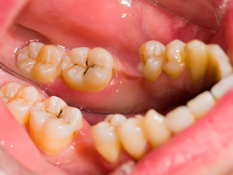 Cirugía para extraer dientes retenidos