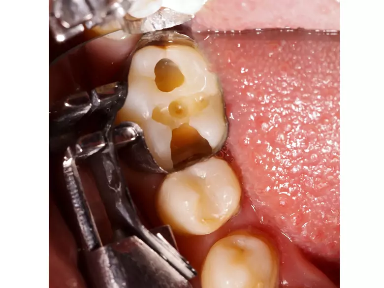 Caries dental - causas, síntomas, diagnóstico, tratamiento