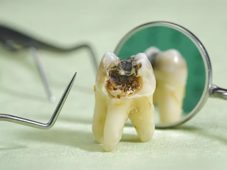  Dislocación y erupción de los dientes de leche - causas, síntomas, diagnóstico, tratamiento