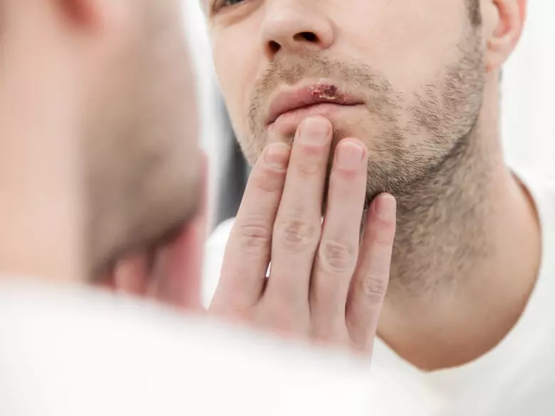 ¿Cómo tratar el herpes?