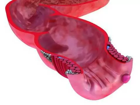 Formación y desarrollo de trombos - trombosis venosa profunda