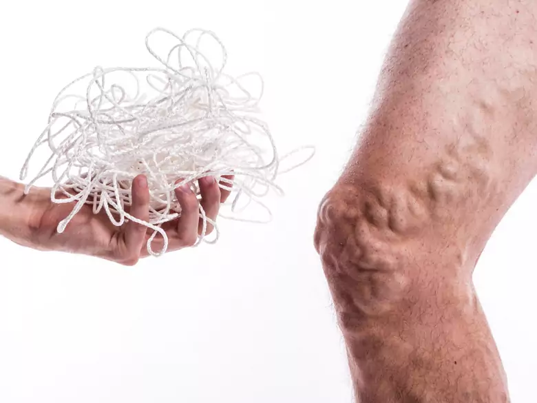 ¿Cómo tratar los problemas de varices?