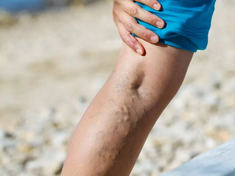 ¿Cómo afrontar los problemas de varices?